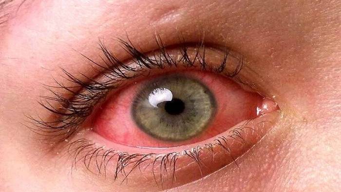 علل و عوامل قرمزی چشم