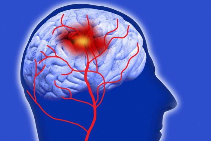 نشانه ها و علائم تشخیص سکته مغزی