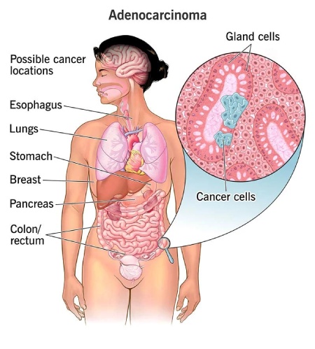 آدنوکارسینوما چه نوع سرطانی است که می‌تواند در هر جایی رخ دهد