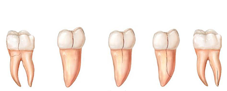 چه عواملی موجب ایجاد شقاق دندان می شود؟