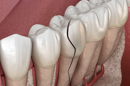 چه عواملی موجب ایجاد شقاق دندان می شود؟