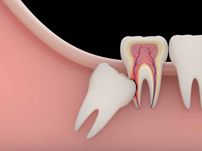 عوارض دندان عقل بر دندان های دیگر